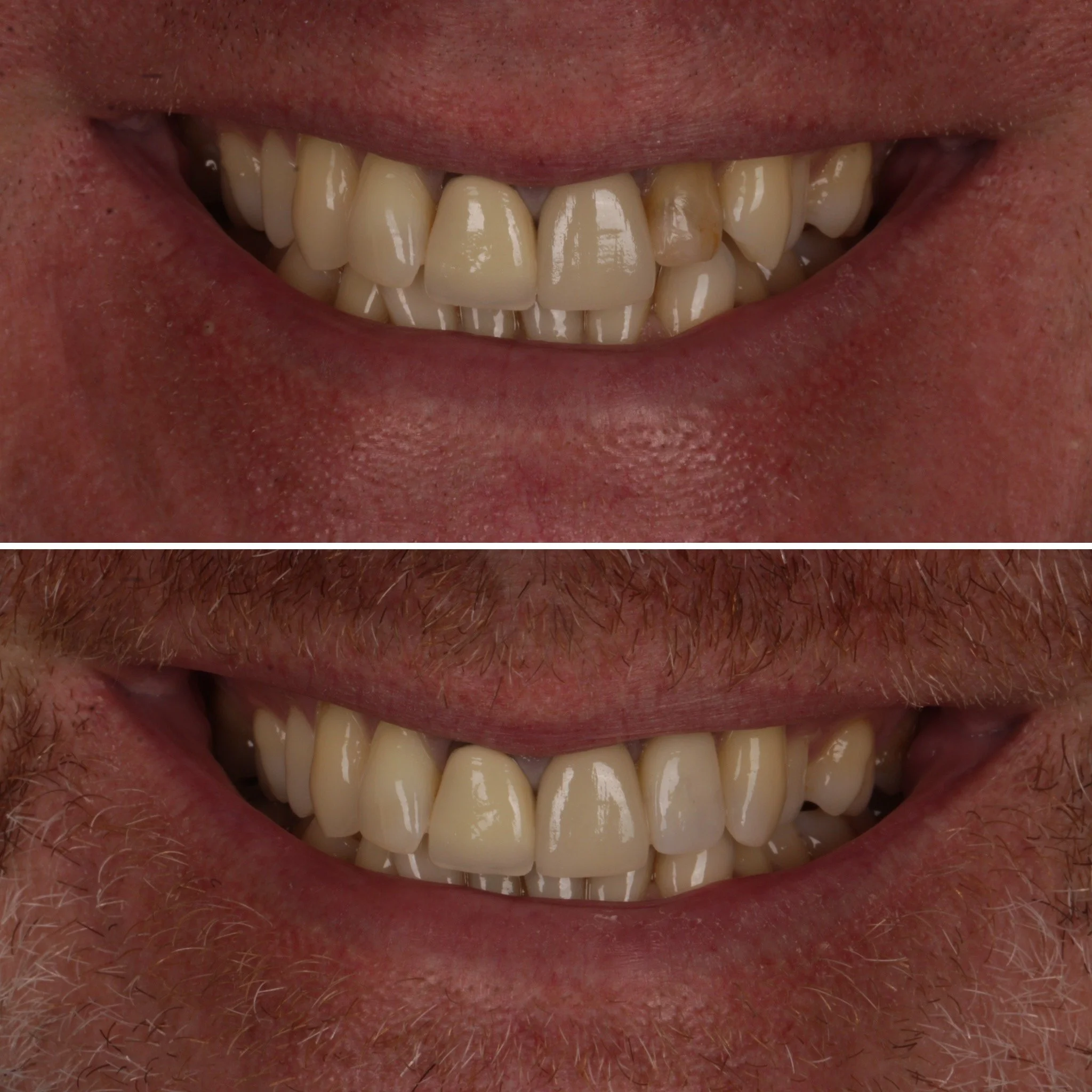 Close-up of a smiling person's teeth before and after dental treatment, showing improved alignment and cleanliness.