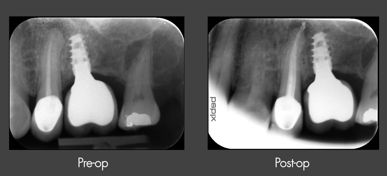 Dental X-ray showing pre-operative image with a dental implant, root canal-treated tooth, and surrounding teeth; post-operative X-ray showing the dental implant in place.