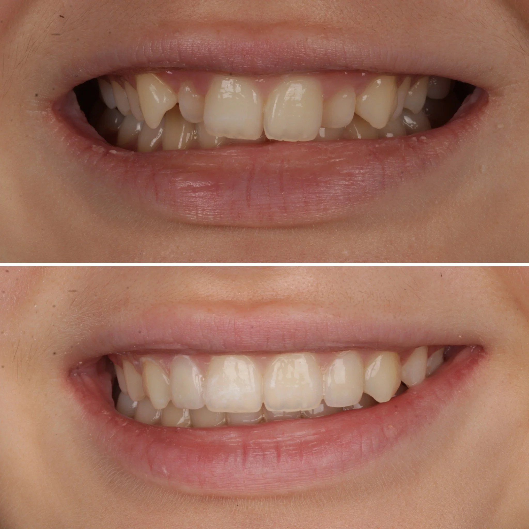 Before and after photos of a person's smile showing improved teeth alignment and appearance.