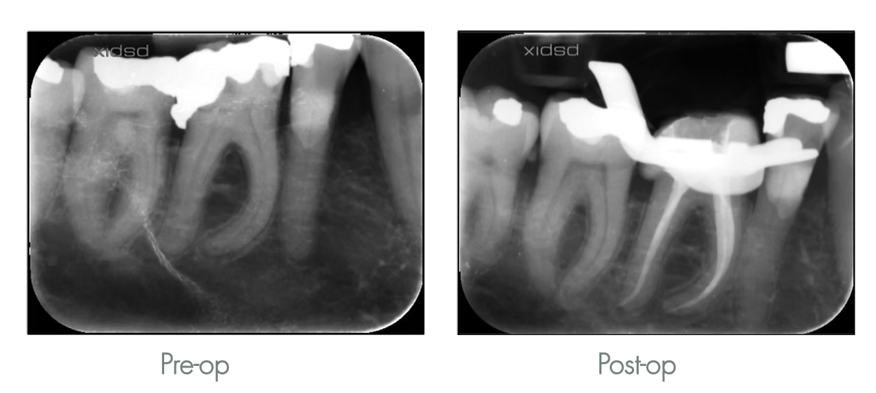 X-ray images of teeth before and after dental procedure, showing root canals and dental restorations.