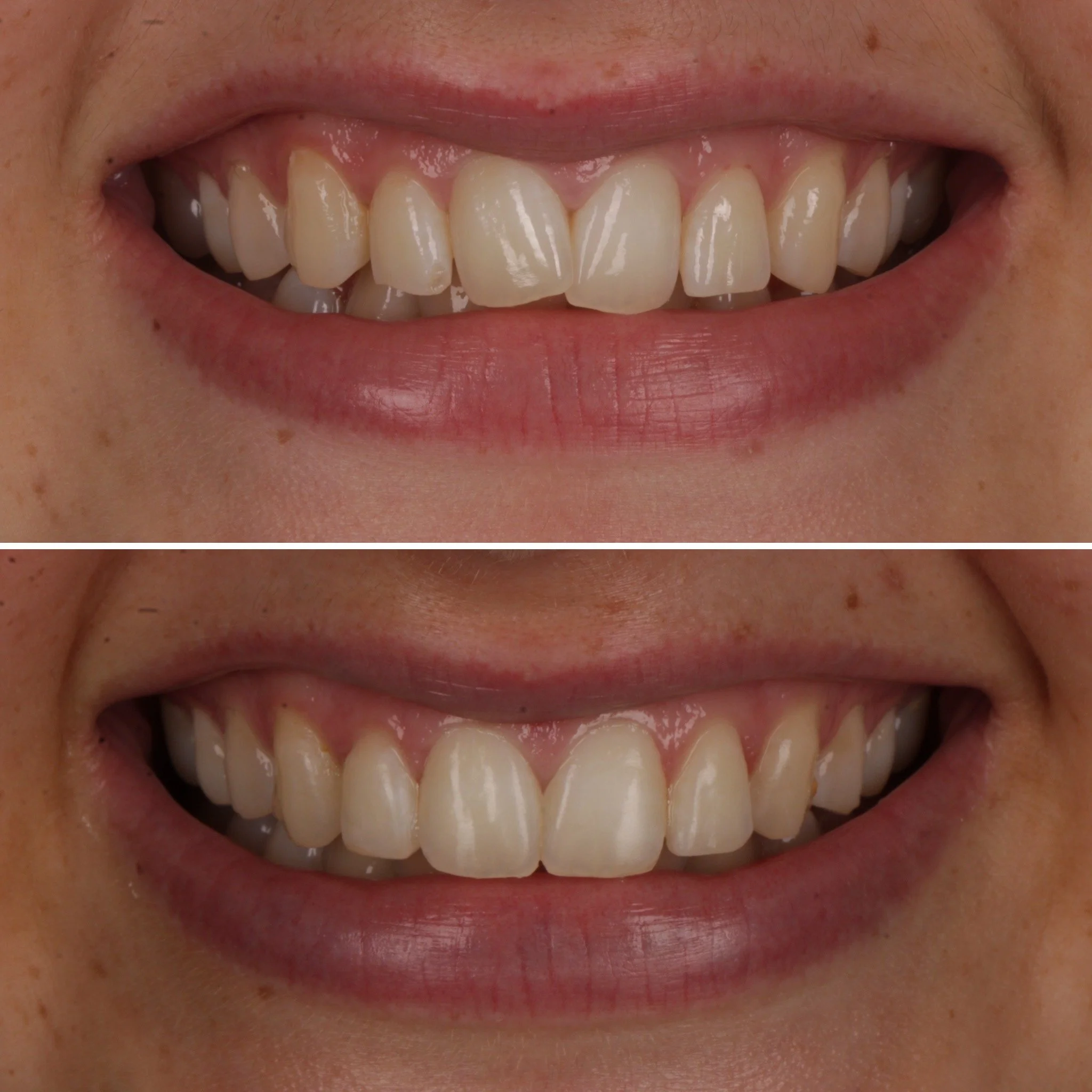 Close-up of a person's smiling mouth showing upper and lower teeth before and after dental treatment.