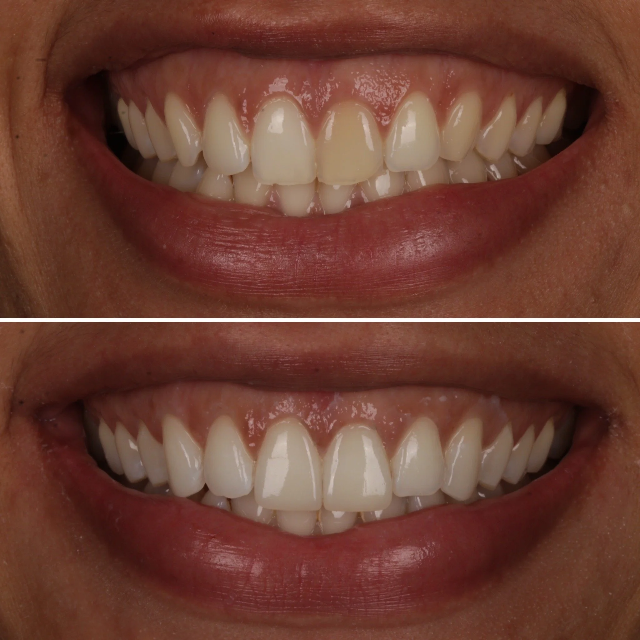 Comparison of teeth before and after dental whitening, showing brighter and more uniform teeth in the bottom image.