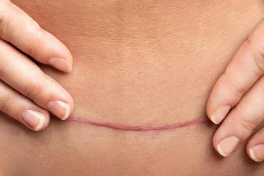 Do I Need Pelvic Floor Therapy If I Had a C-Section?
