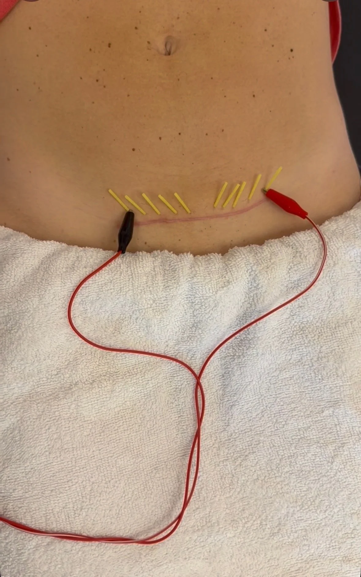 C-Section Dry Needling: A Powerful Tool for Postpartum Recovery