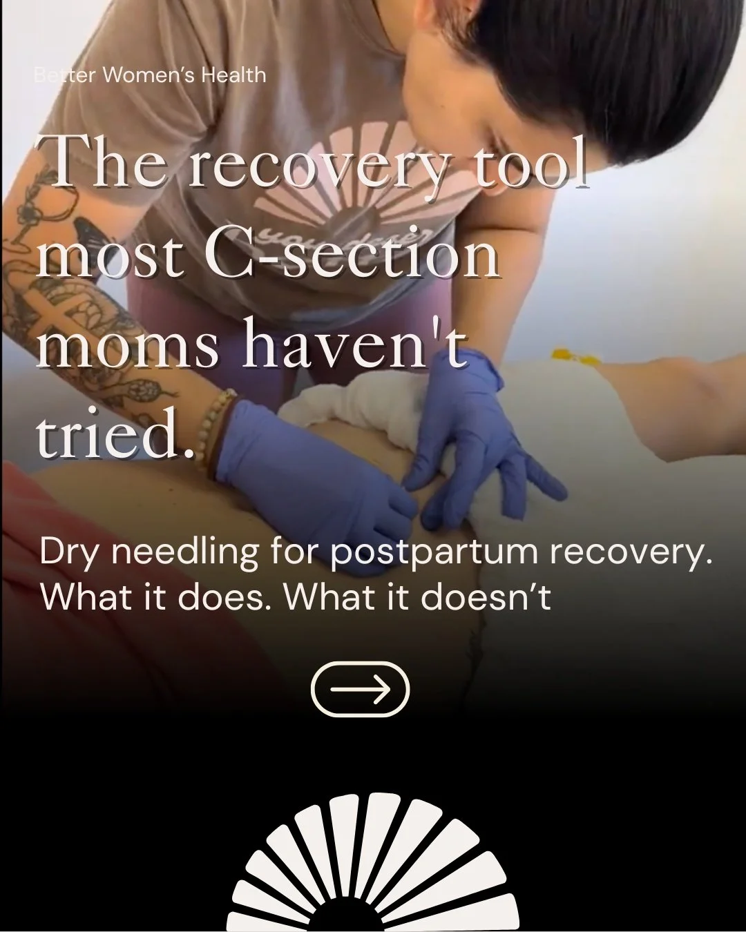The recovery tool most C-section moms have never tried.

Your scar healed. Your deep core didn't get the memo. Dry needling reaches what hands can't, and the relief usually shows up on day 2.

If your hips still feel "off" or your core won'
