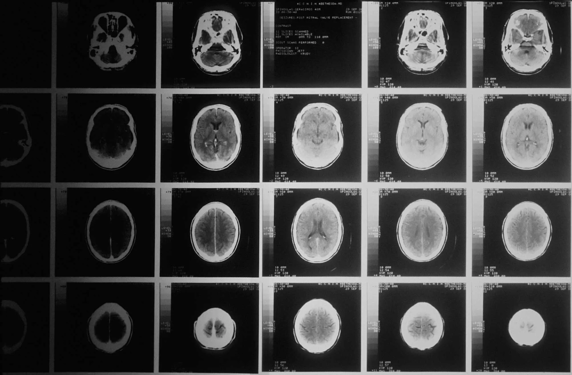 Belly Fat Linked to Dementia? Here’s What to Stop Eating
