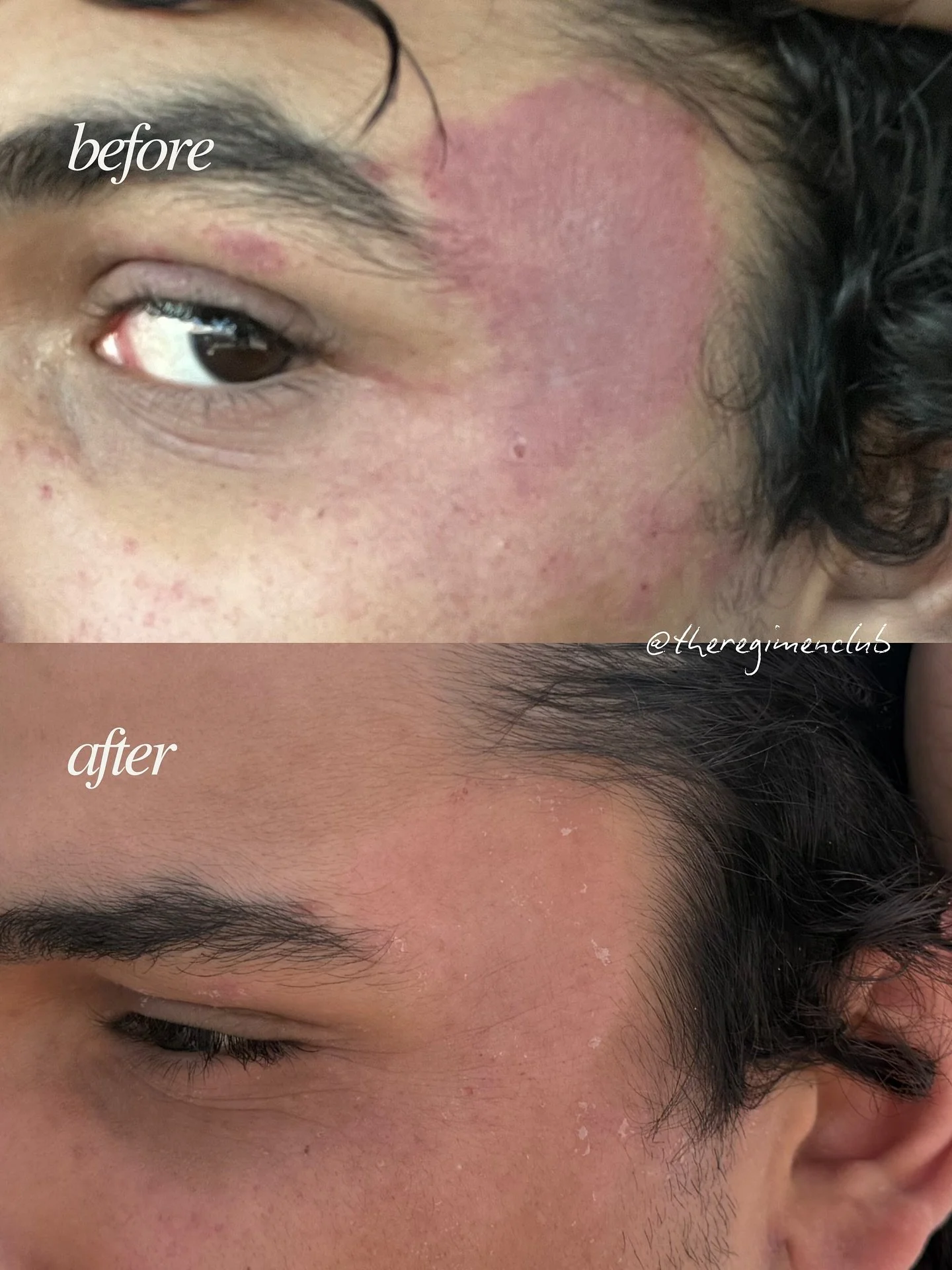 ✨Healthy skin loading ✨

Aerolase helps calm eczema flare-ups by soothing inflammation, evening tone, and strengthening the skin barrier all without downtime or irritation 

Gentle, effective, and safe for every skin type! 

Ready to calm your eczema