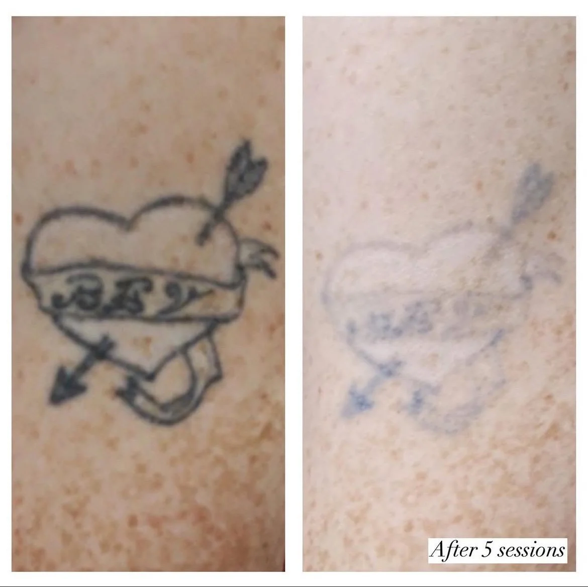 Comparison of tattoo of a heart with an arrow and a banner, with fading after five sessions.