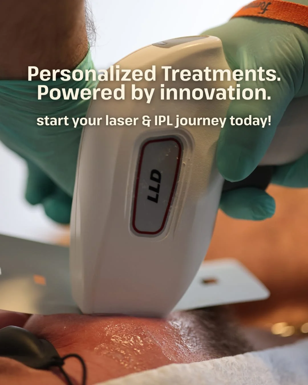From precision Laser Hair Removal to targeted IPL (Intense Pulsed Light) Skin Rejuvenation treatments &mdash; Bod&eacute;&trade; offers advanced solutions for smooth, clear, and confident skin.

Book your consultation online via the link in our bio. 