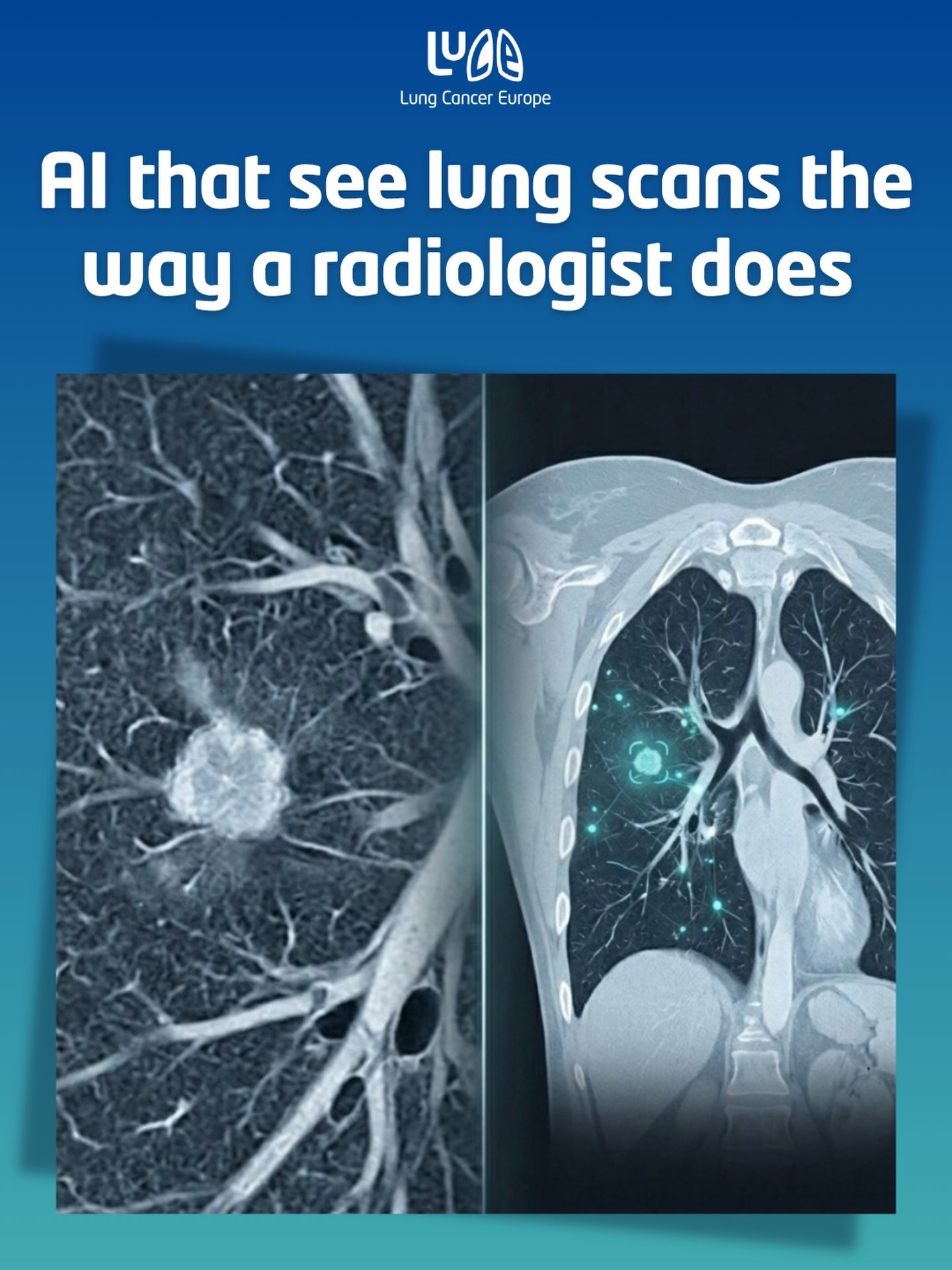 A Second Pair of Eyes for Lung Cancer Detection 🫁

Timing is everything in lung cancer diagnosis. Finding it early is the most important factor in ensuring the best possible outcome.

But reading a CT scan isn&rsquo;t simple. Most spots found on lun