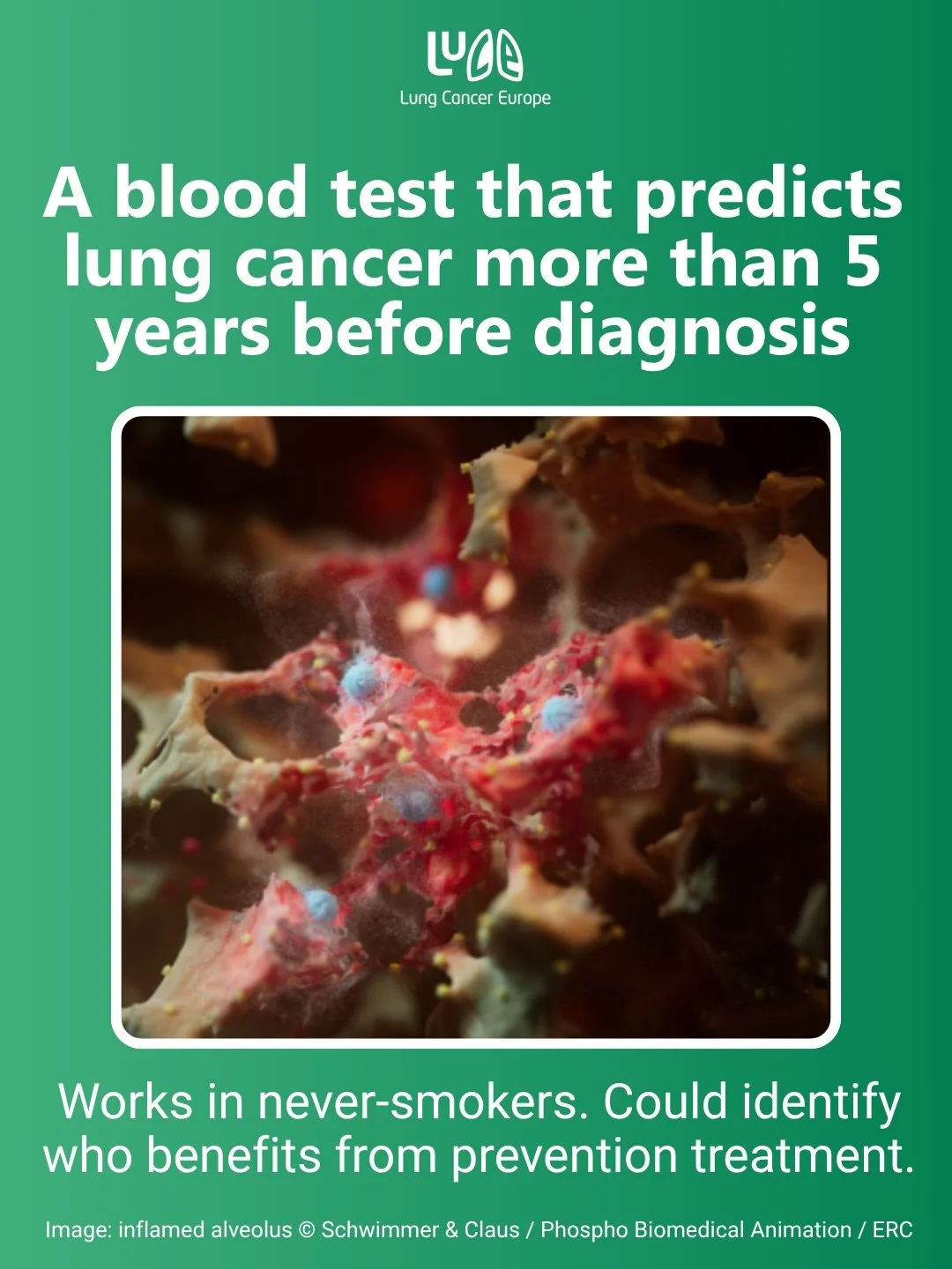 ‼️ Landmark lung cancer research just published in Cell.

Scientists at the Francis Crick Institute and UCL, led by Professor Charles Swanton, have discovered a 14-protein blood signature that predicts lung cancer more than 5 years before diagnosis a