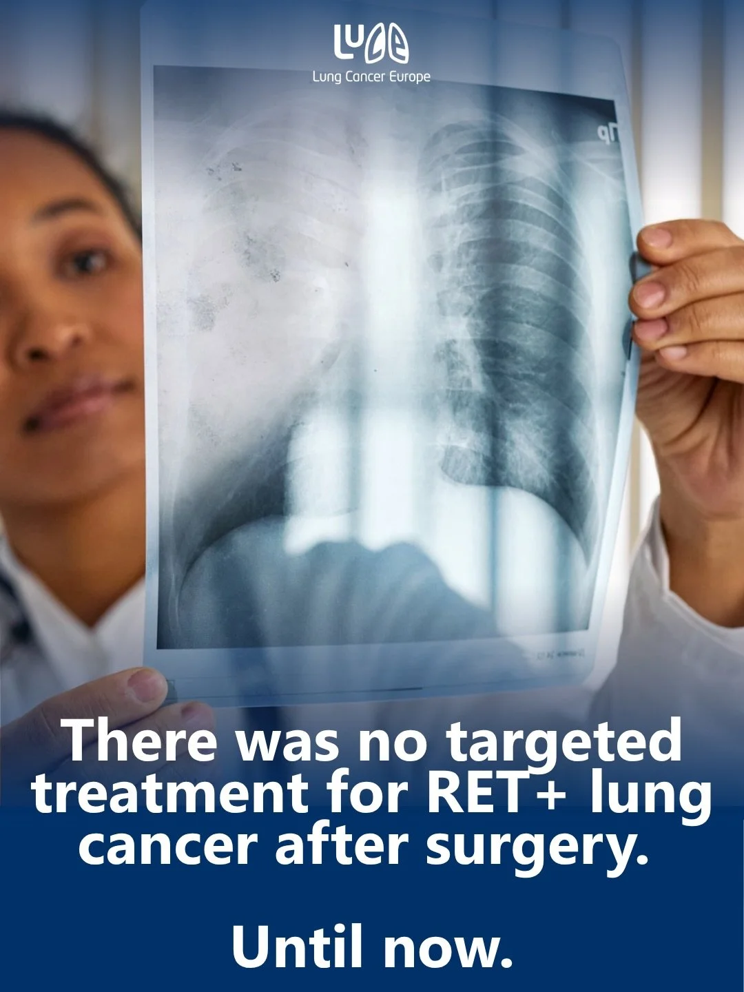 RET fusions drive around 1 to 2% of lung cancers. They tend to occur in younger adults who have never smoked, and more often in women.

New results from the LIBRETTO-432 trial, presented at ASCO 2026, show for the first time that a targeted treatment