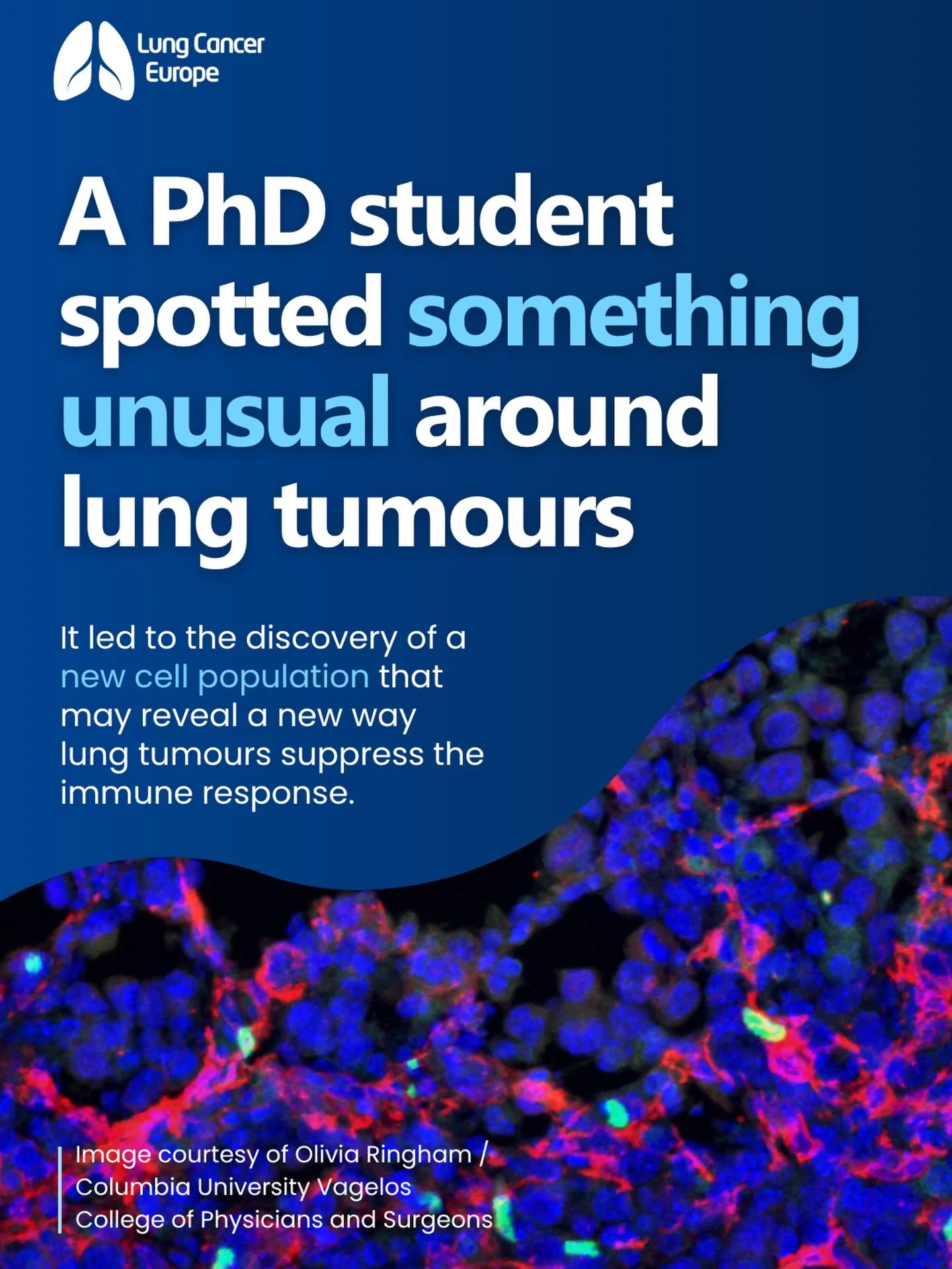 Sometimes a discovery starts with someone noticing something odd.

During her PhD at Columbia University, Olivia Ringham was looking at lung cancer tissue when she noticed regulatory T cells gathering around fibroblasts at the edge of tumours.

That 