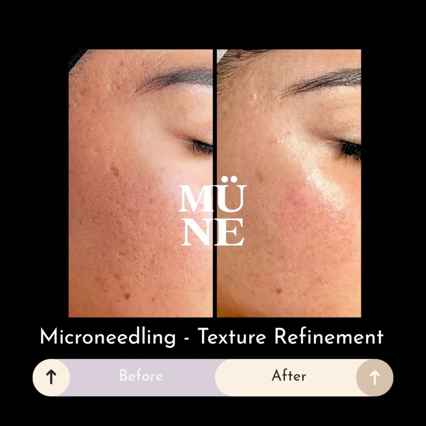 Texture refinement through collagen stimulation ✨

This client completed a progressive microneedling series designed to support skin renewal and improve overall texture. Treatment builds cumulatively, encouraging collagen activity and healthier skin 