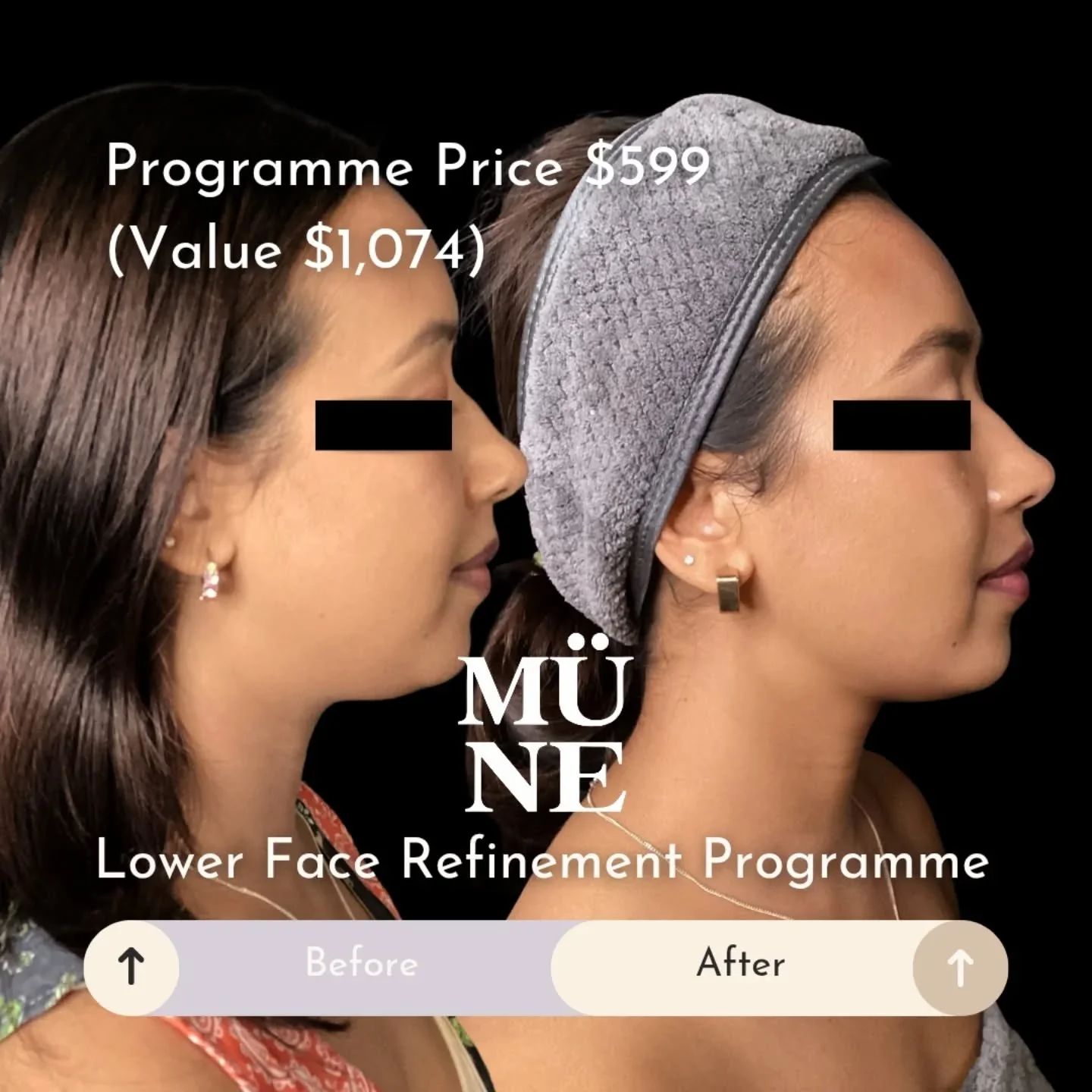 Introducing the Lower Face Refinement Programme.

This structured programme combines targeted fat reduction, advanced tissue tightening, and personalised skin preparation to support improved jawline definition and overall lower face refinement over t