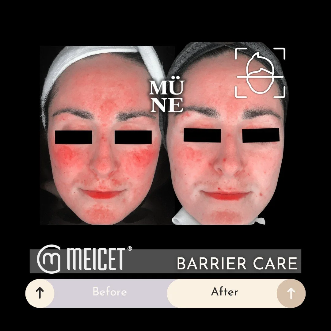 Barrier repair isn&rsquo;t a trend. It&rsquo;s the foundation.

These scan images show the same client, 2 months apart, following our signature Prep &amp; Protect Skincare System.

No devices. No peels. No energy-based treatments.

Just intentional b