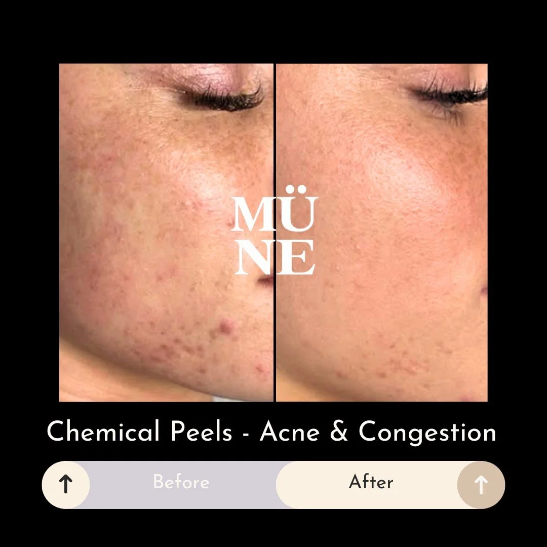 Congested and breakout-prone skin is one of the most common concerns we see in clinic.

Professional chemical peels, including formulations containing azelaic acid and the mesoestetic&reg; Blemiskin system, are often incorporated into treatment plans