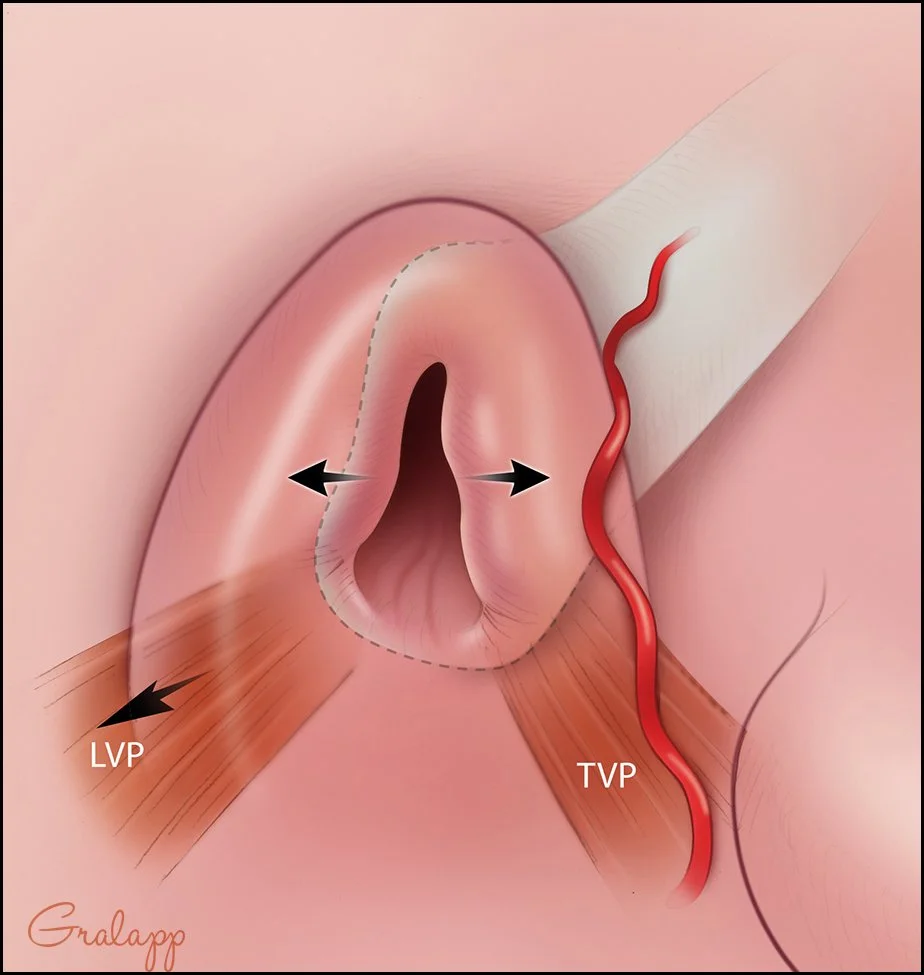 Eustachian tube opening mechanism driven by the tenor and levator muscles
