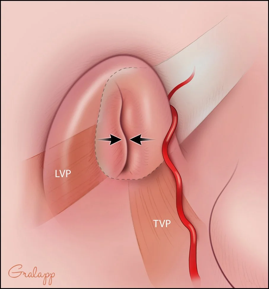 The Eustachian tube closed.  LVP, levator veli palatini; TVP, tensor veli palatini