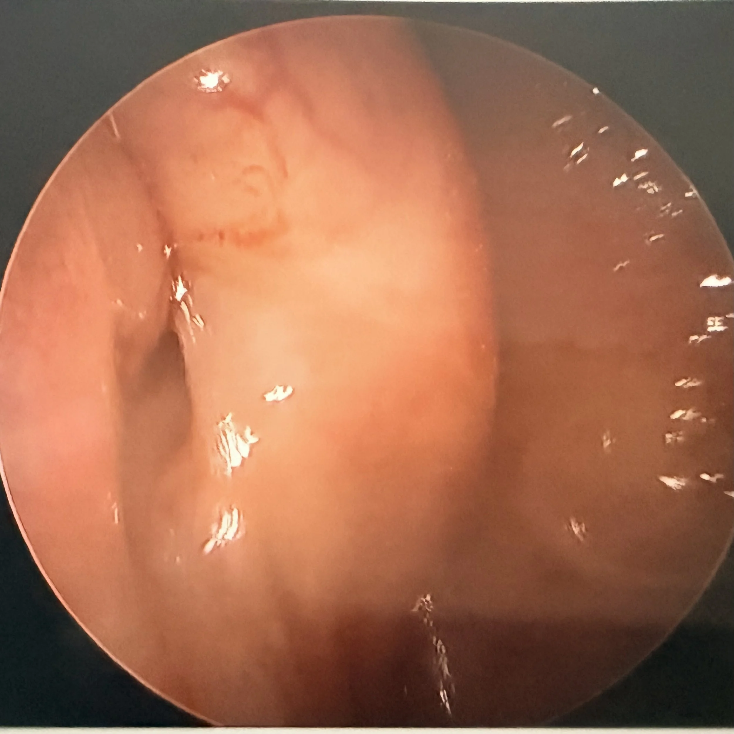 Endoscopic view of intestinal lining showing smooth, pink tissue with some blood vessels and small protrusions.