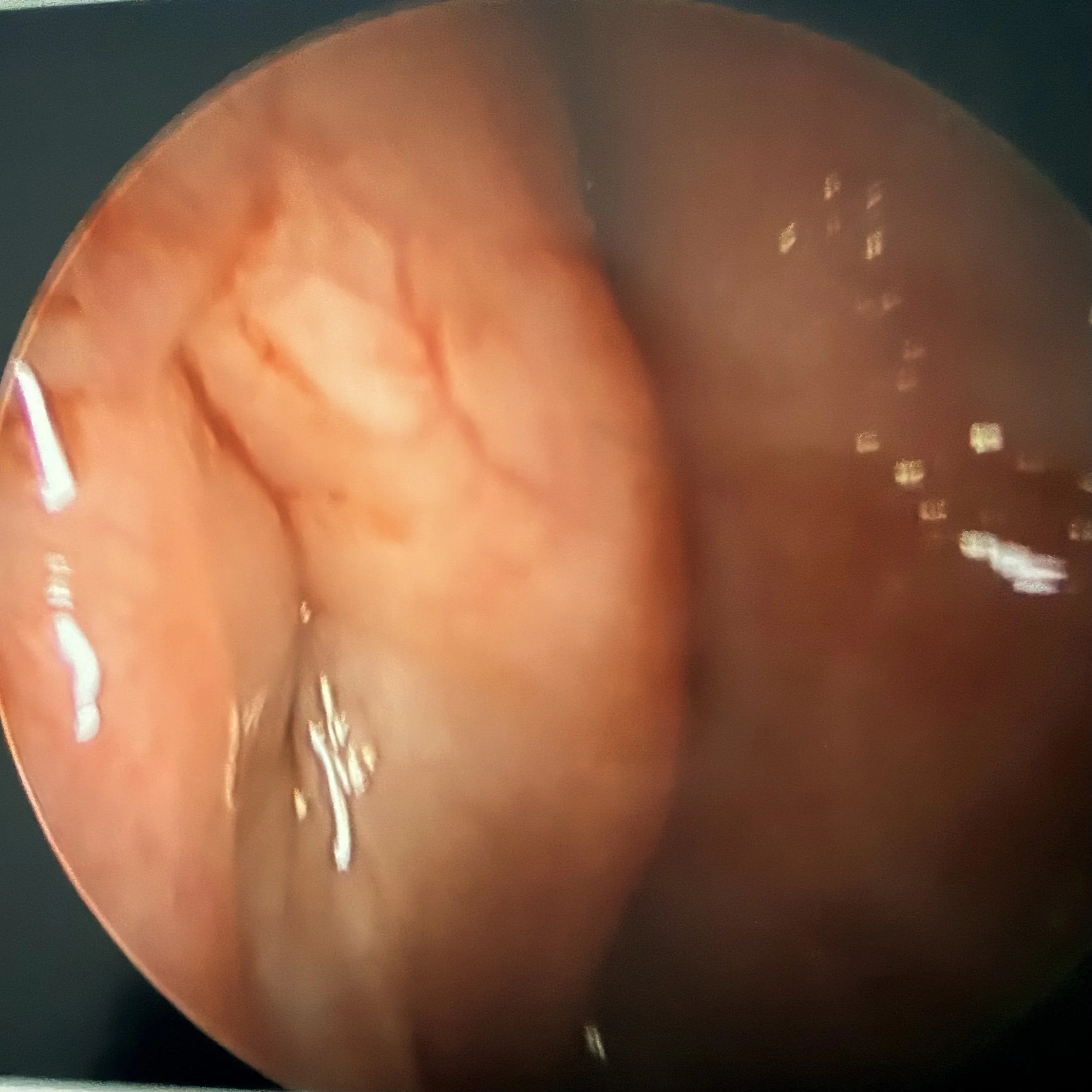 Endoscopic view of a closed eustachian tube following surgery