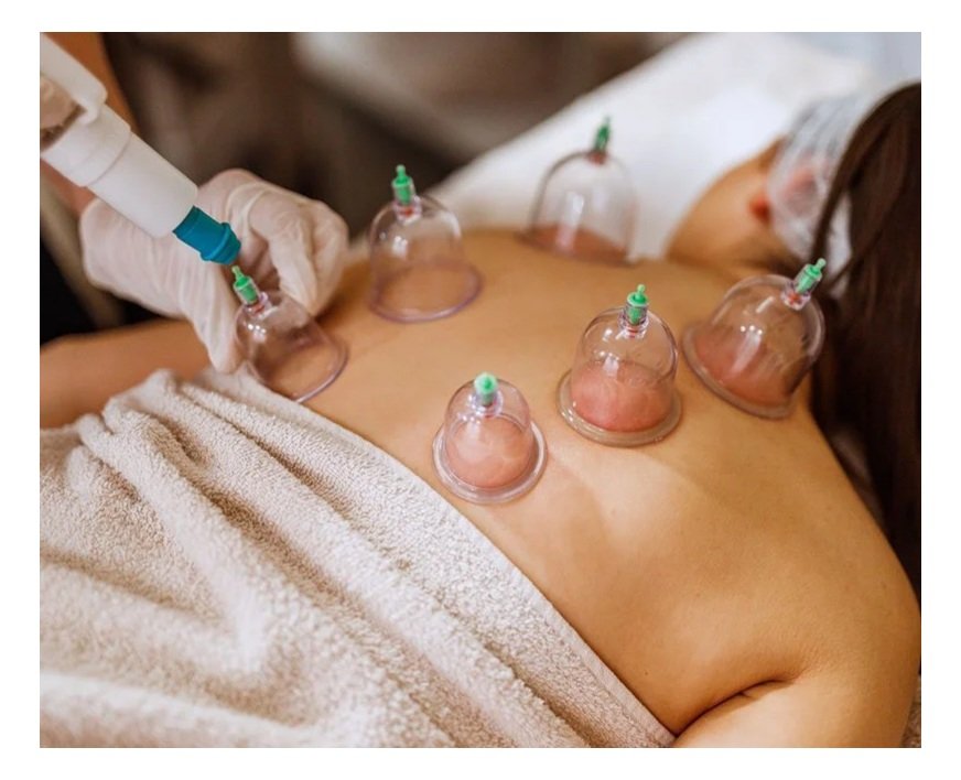 A person receiving cupping therapy on their back with multiple suction cups attached.