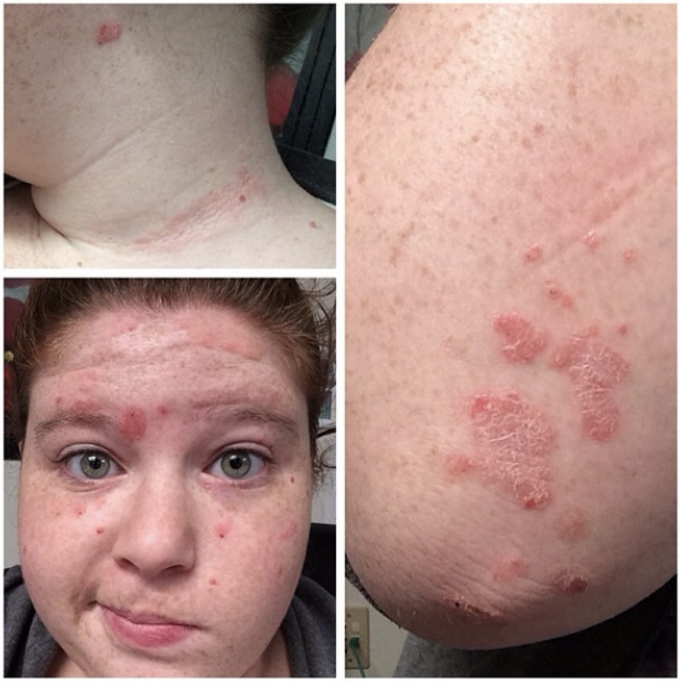 Psoriasis Jan 2014
