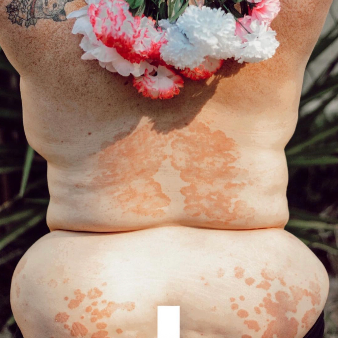 Psoriasis March 2020