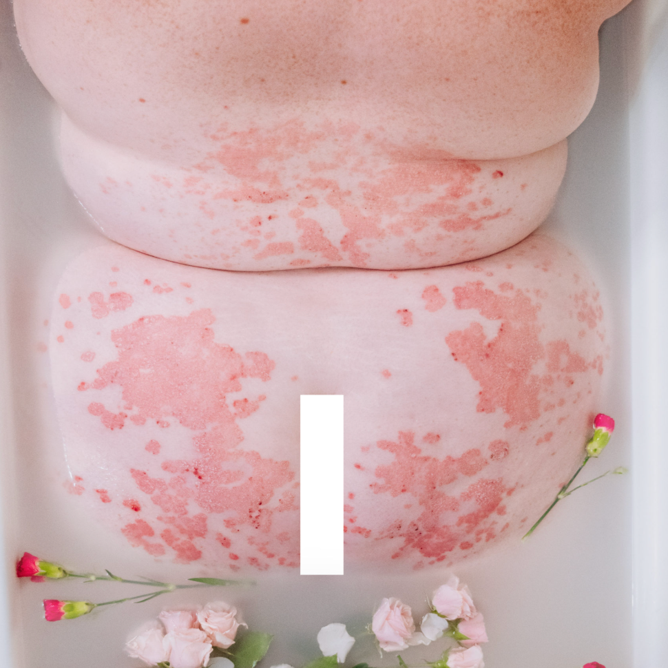 Psoriasis Nov 2020