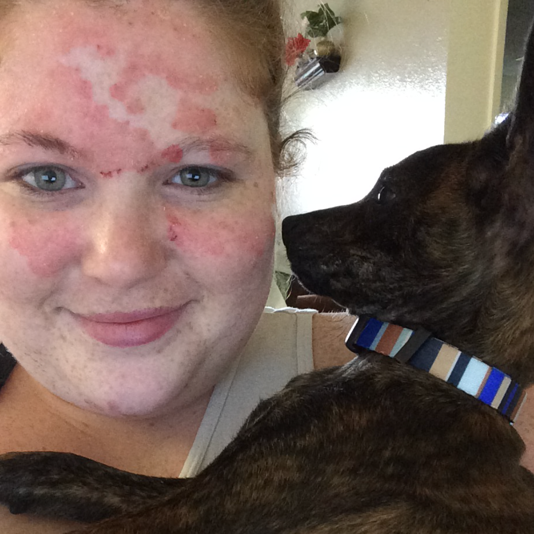Psoriasis April 2015