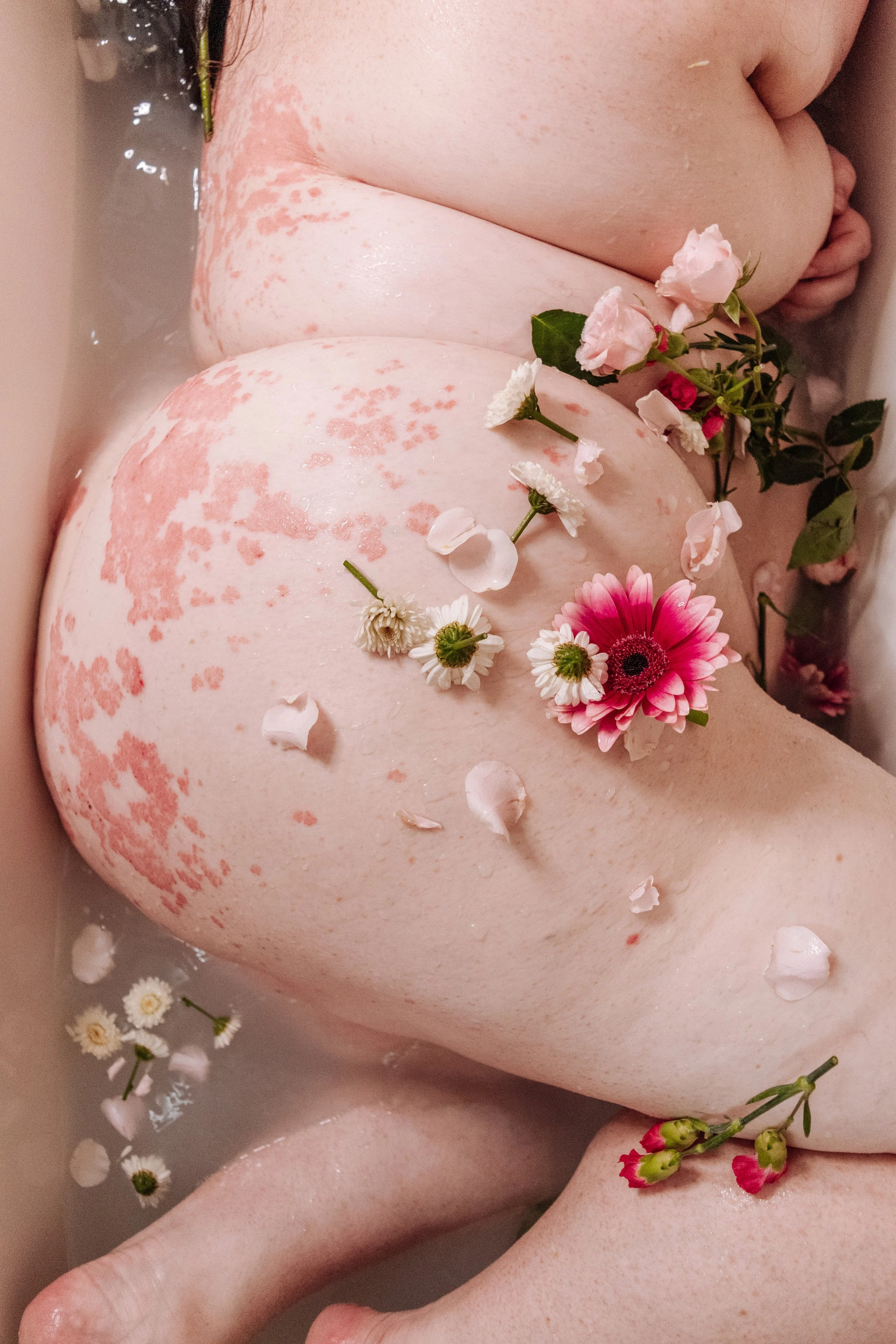 Living with Psoriasis: My Story, Struggles, and Treatments
