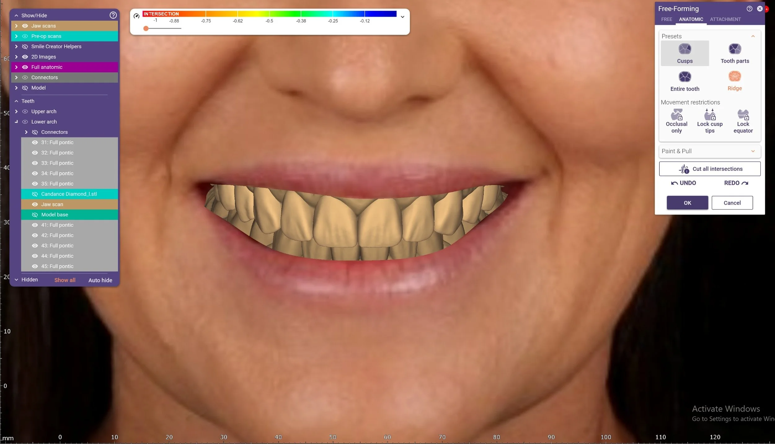smile design CAD CAM