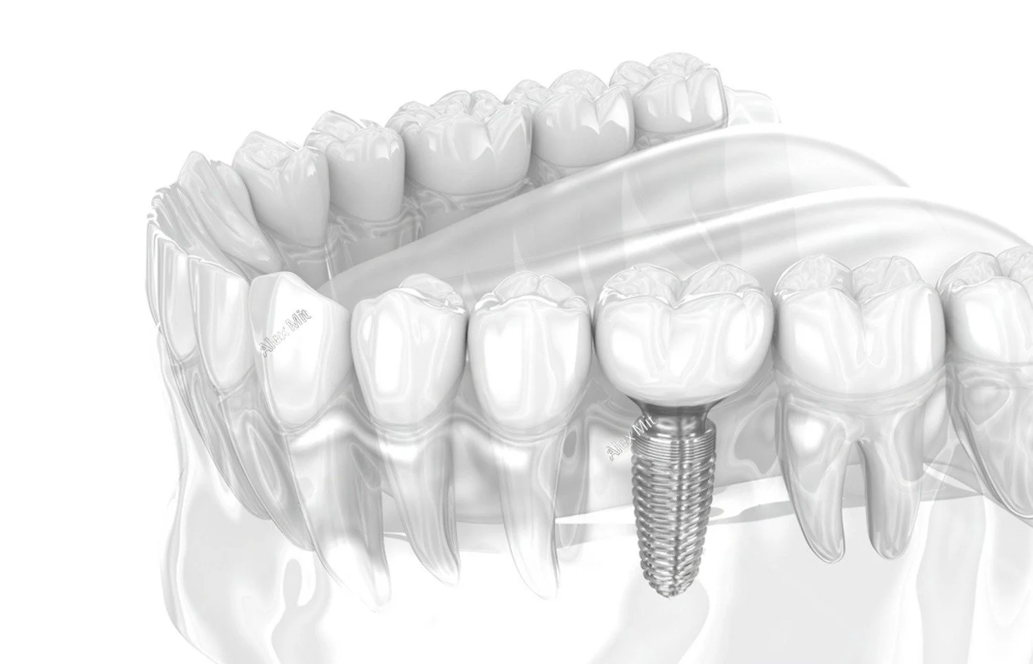 Implants