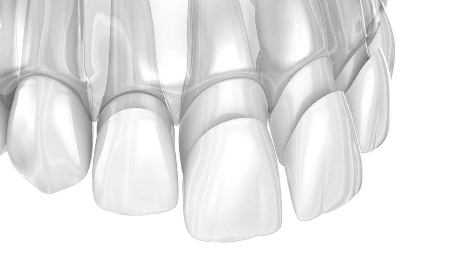 Veneers