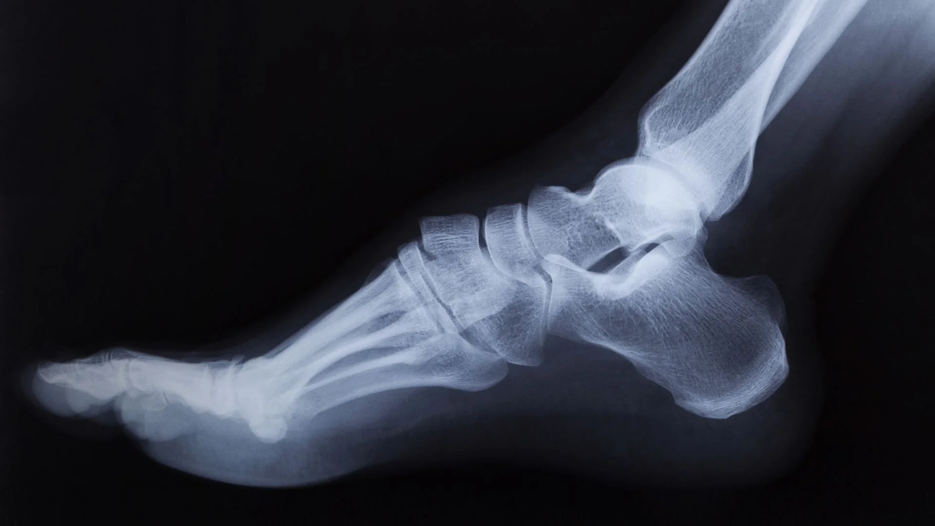 xray image of a human foot