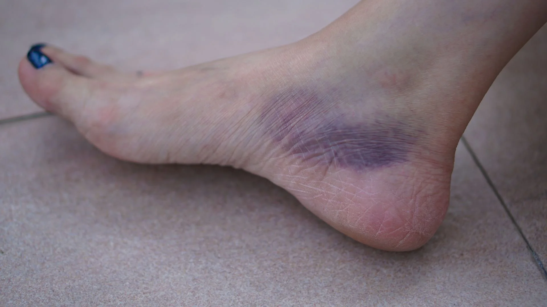 photo of a female foot with a bruised ankle