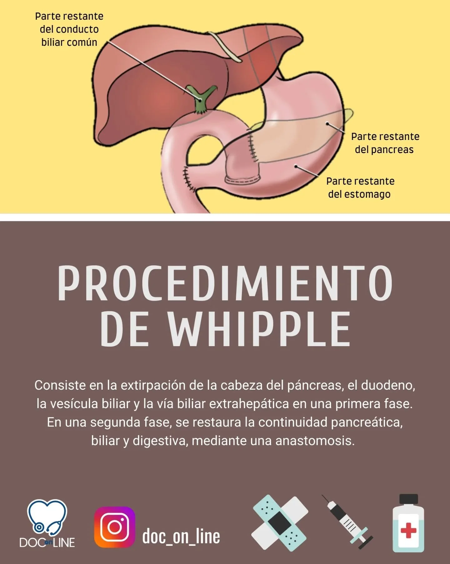 Procedimiento de Whipple 

📌Aprende f&aacute;cil

#procedimientodewhipple #cancerdepancreas #irrigacion #duodeno #duodenopancreatectomy #viabiliar