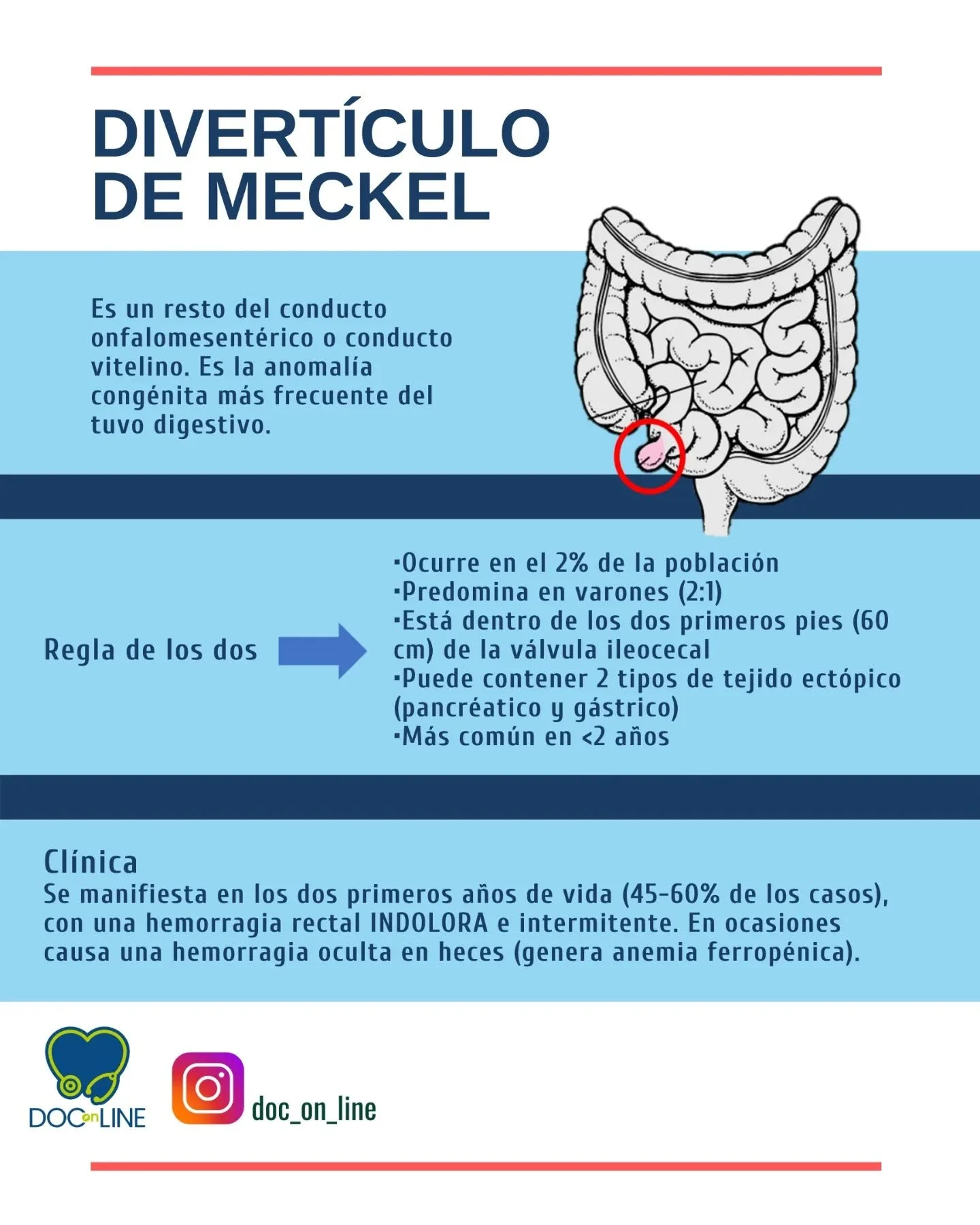 Divert&iacute;culo de Meckel

📌Aprende f&aacute;cil

#divert&iacute;culodemeckel #cirugia #hemorragia #aprenderesfacil #pediatria