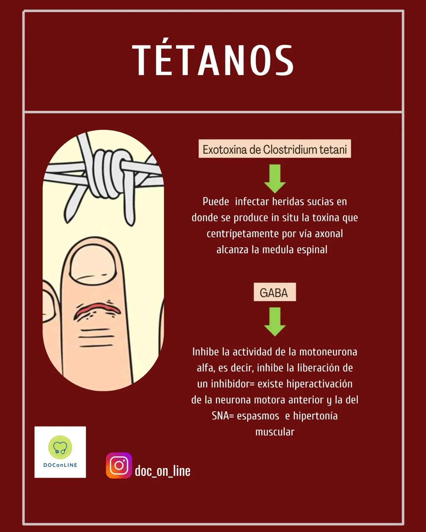 T&eacute;tanos y botulismo. 

📌Aprende f&aacute;cil

#tetanos #botulismo #miel #risasardonica #paralisisdeparescraneales #midriasis #medicinafacil