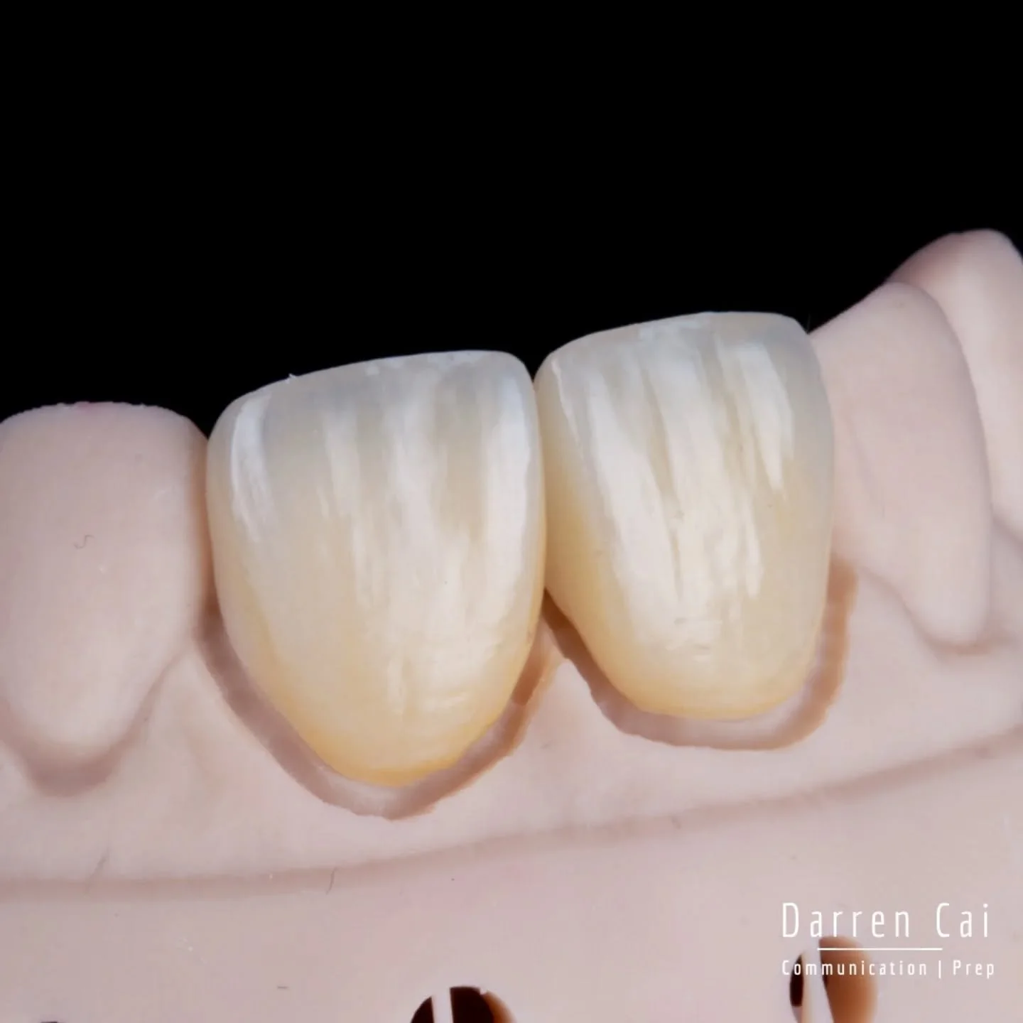 She was always nervous about her front teeth.
They were repaired with composite after composite - because without private health cover, quick fixes felt like the only option.

But when her 11 fractured almost completely and a huge 5-surface composite