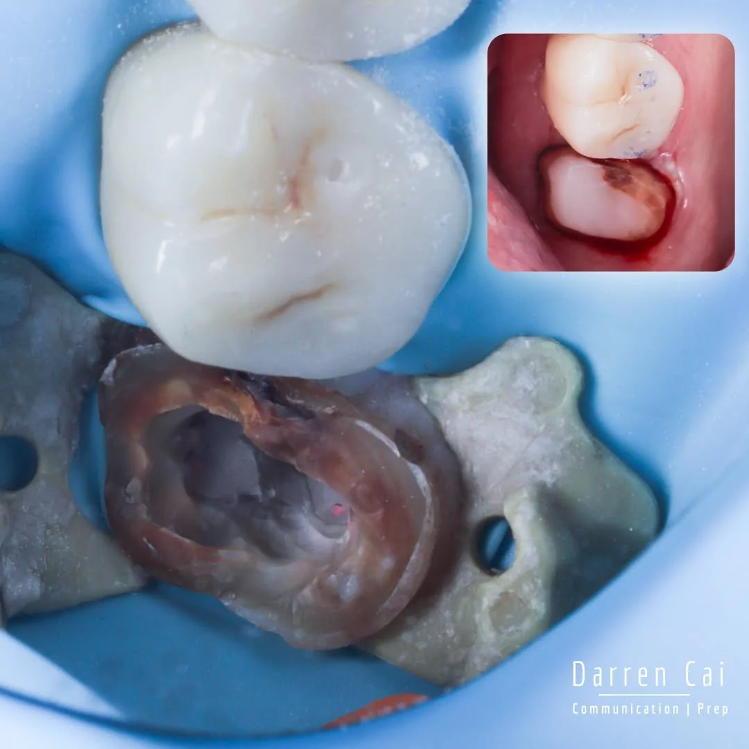 &quot;Why is it hurting now after so long?&quot;

This patient in his mid 80s had a 30-year-old gold crown and suddenly experienced ongoing pain. 

There are times when patients aren&rsquo;t ready for bad news. Here, he kept dwelling on why it happen