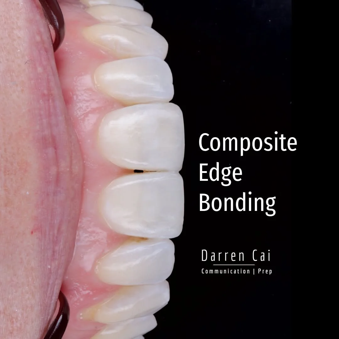 Swipe to see the assessment and results

Whitening and Edge Bonding

She expressed a long-standing desire to address concerns with her anterior aesthetics. Her trained social smile hid several issues:

&bull; Chipped anterior incisal edges
&bull; Sta