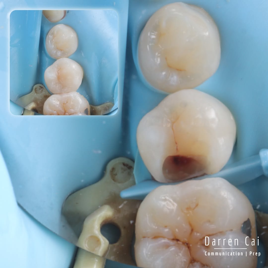 One of my first posts on here was replacing defective composites 🦷August 2023 vibes.

Fast forward to now&hellip; I still do composites every single day as a general dentist. Literally my memory card is full of them 😅

Was thinking&hellip; wow, it&