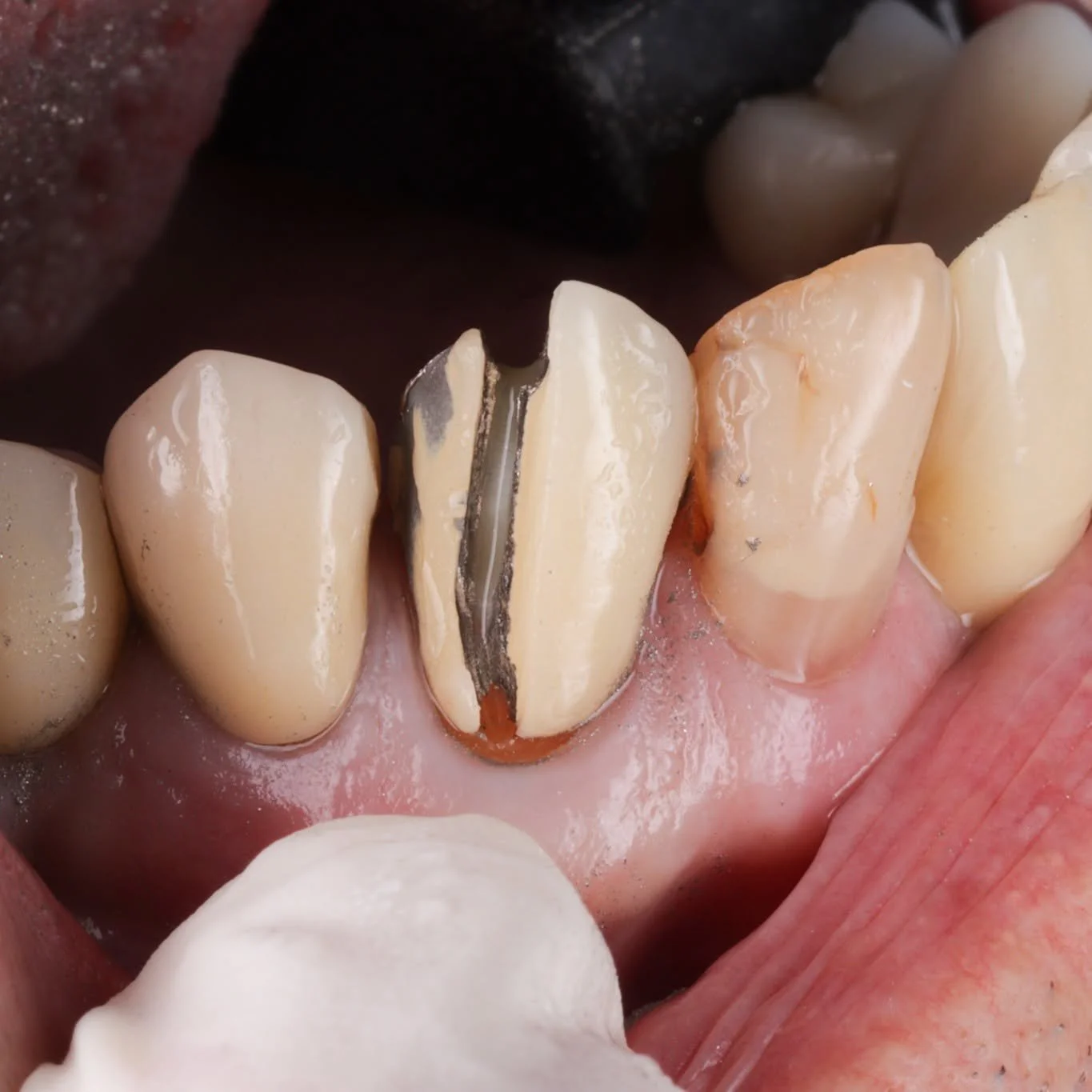 The patient is a retired dental technician. 

There&rsquo;s a certain pressure when your patient knows the craft - but the fundamentals don&rsquo;t change.

Deconstruct carefully. Assess thoroughly. See it as a chance to rebuild!

I layered composite