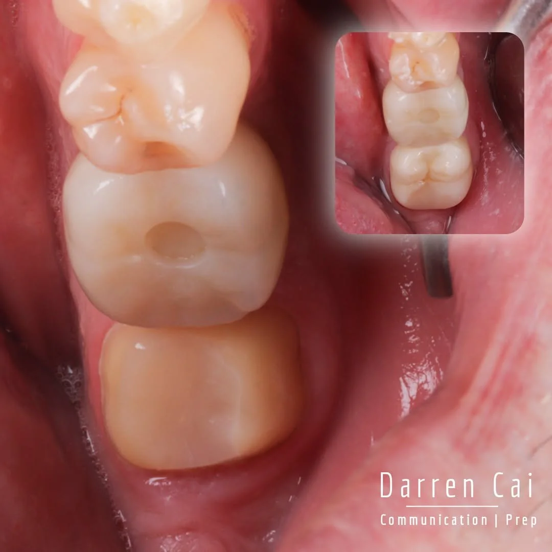 &ldquo;If this tooth lasts me even another year&hellip; it&rsquo;s worth it.&rdquo;

Emergency patient came in with severe pain from 47.
No sleep. Already on antibiotics. Feeling like he was losing another tooth.

He had his 46 extracted and an impla