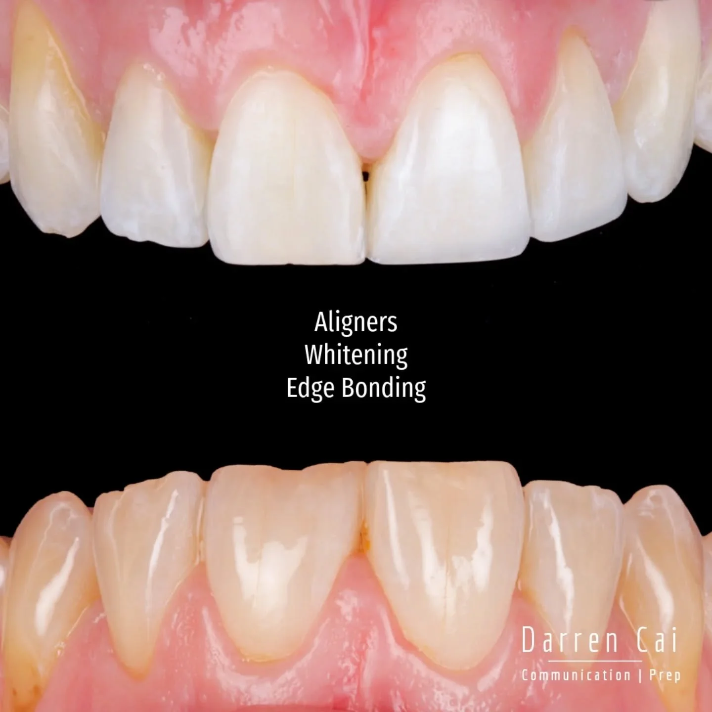 Sometimes the best aesthetic dentistry starts with doing less.

This patient initially presented wanting the shape of 21 and 22 improved due to wear. Rather than jumping straight into bonding, we focused on creating a better foundation first.

Treatm