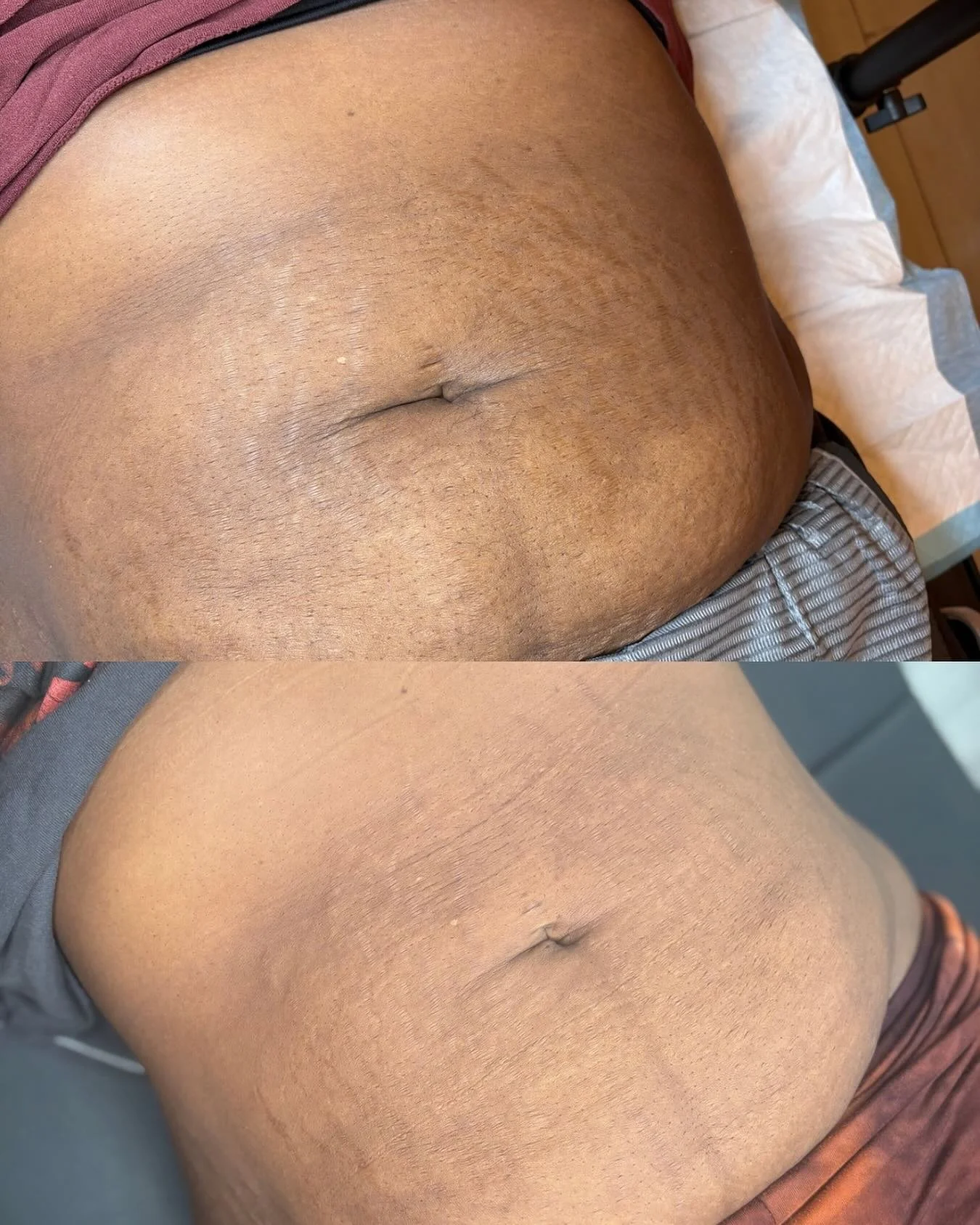 ✨ Inkless Stretch Mark Revision ✨
From textured to smoother and more even 🌸

These are real, unfiltered results from one of my beautiful clients after two ISR sessions. You can already see how the stretch marks have softened and blended into the sur