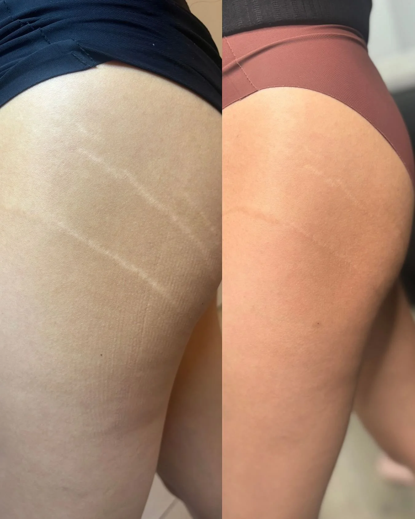 ✨UNLEASHING THE POWER OF ISR✨

💕 This client underwent our Inkless Stretchmark Revision treatment, and the results speak for themselves &mdash; softer, smoother, more even-toned skin with visibly reduced stretchmarks.

This is your reminder: stretch