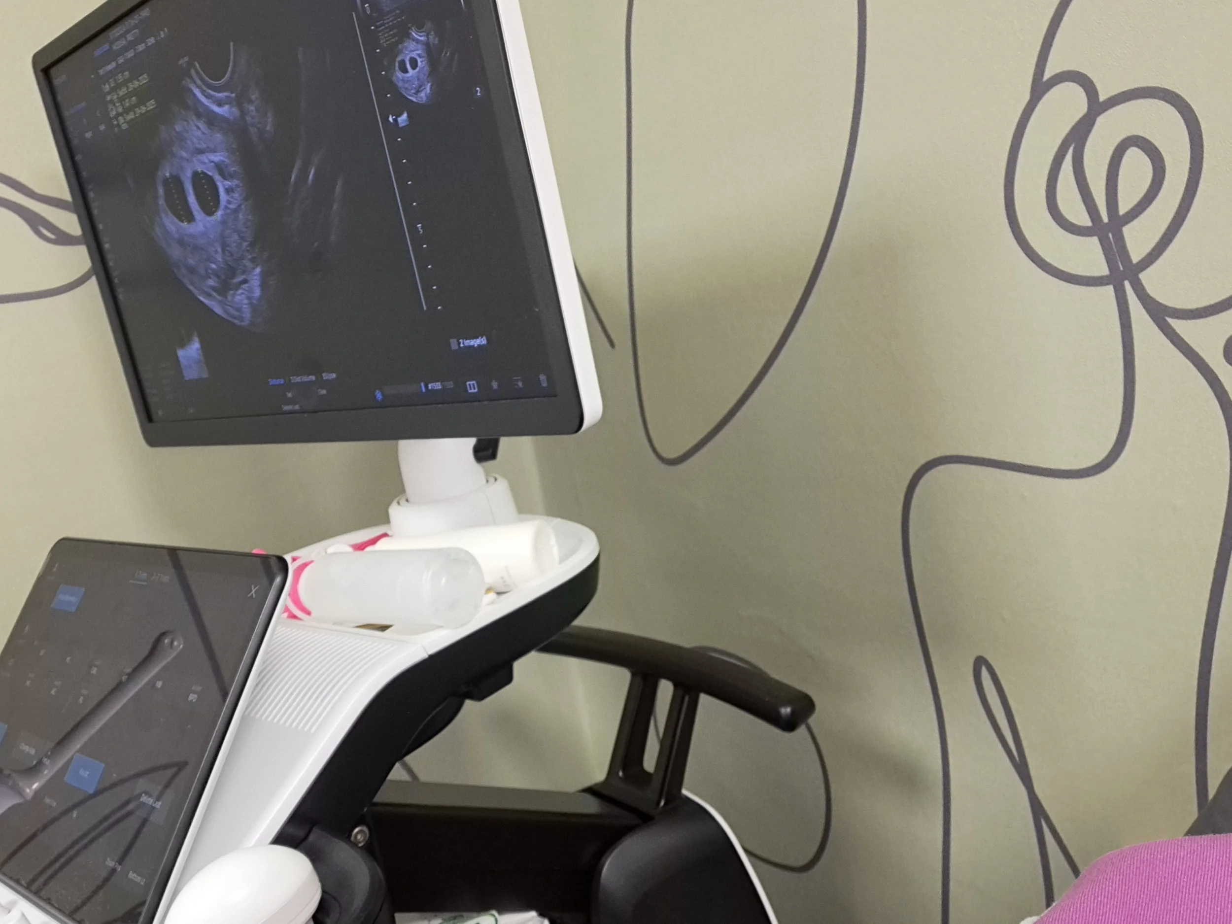 Medical ultrasound machine with a monitor displaying black-and-white ultrasound images, situated in a clinical setting with a wall featuring abstract line art in the background.