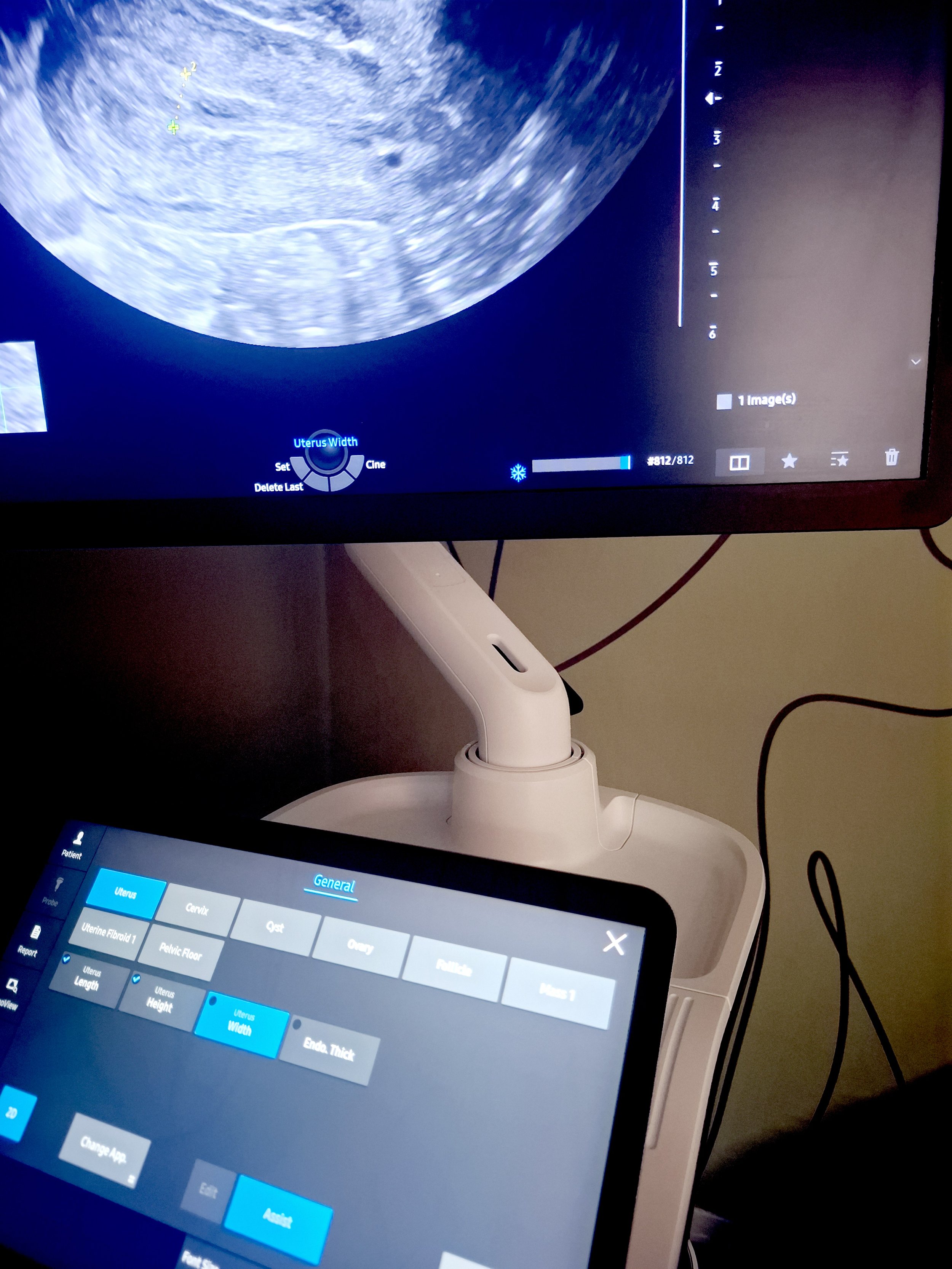 Ultrasound machine screen showing an ultrasound image of a uterus with measurements, and a control panel on a tablet displaying options for uterine measurement settings.
